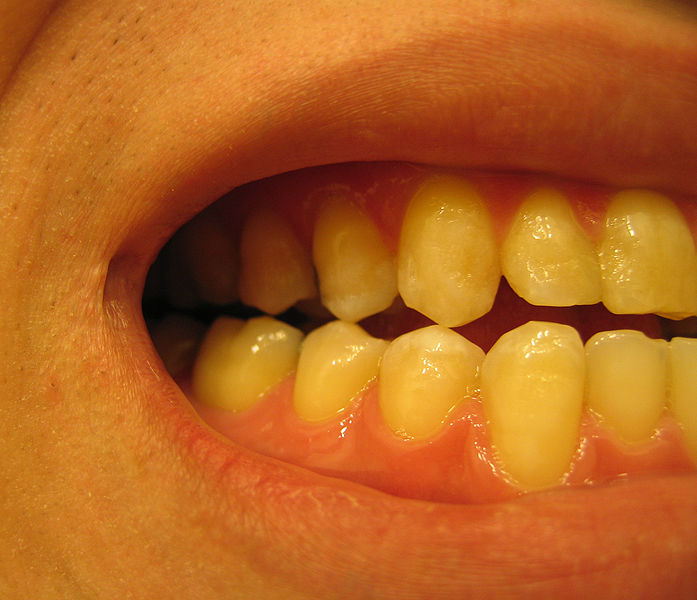 Nadwrażliwość zębów